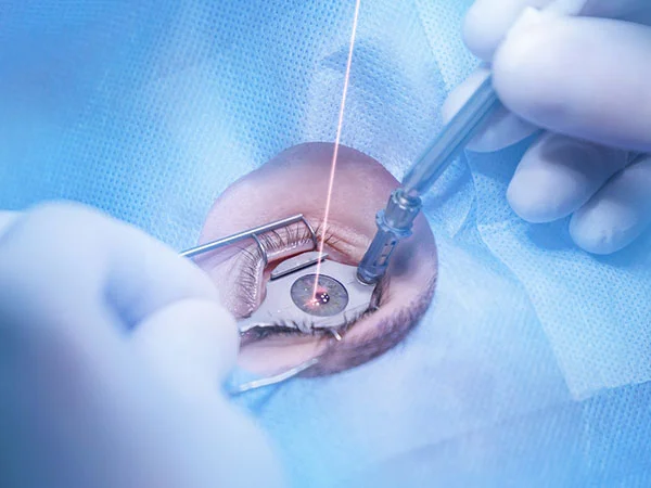 Advanced LASIK treatment for spectacle-free vision