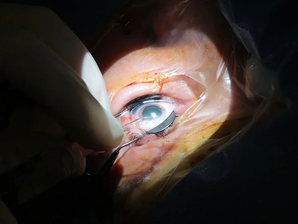 Retinal surgery consultation in Bengaluru