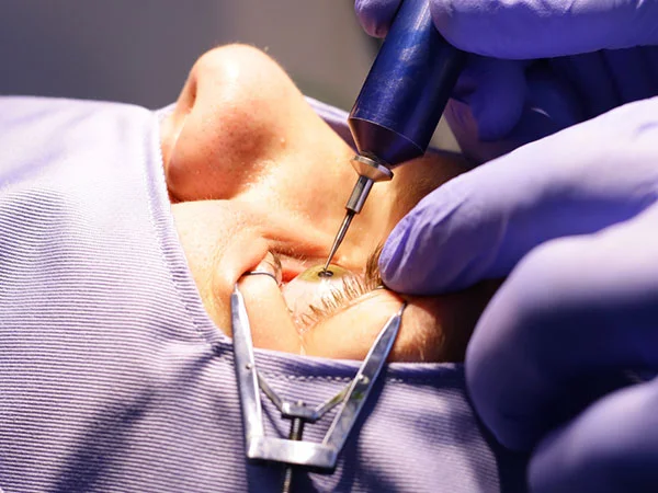 PRK laser eye surgery for permanent vision correction