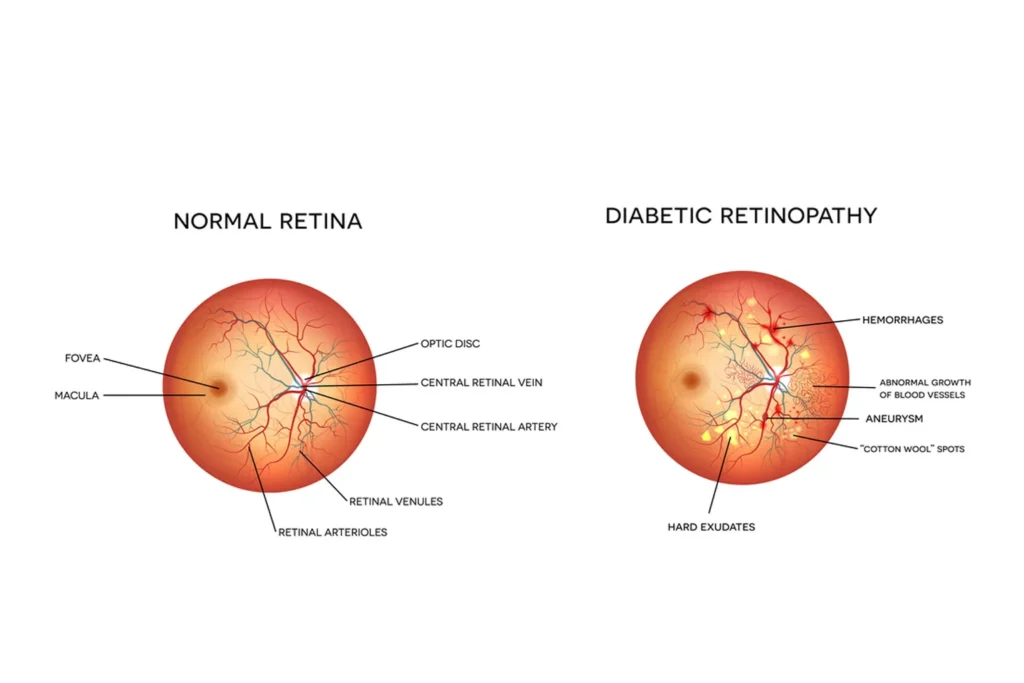 Diabetic retinopathy consultation in Bengaluru