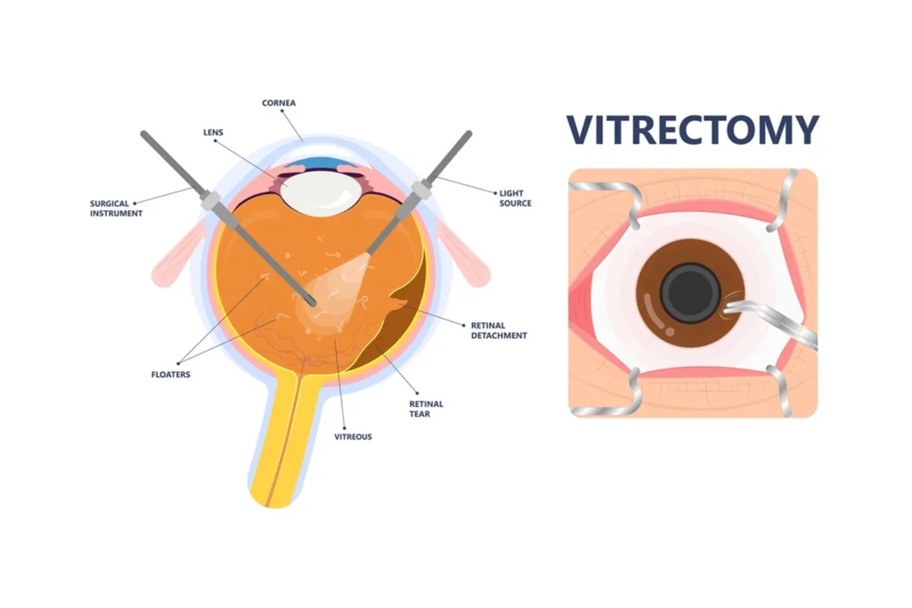 Vitrectomy surgery consultation in Bengaluru